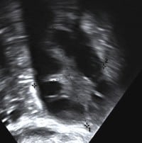 ultrasound